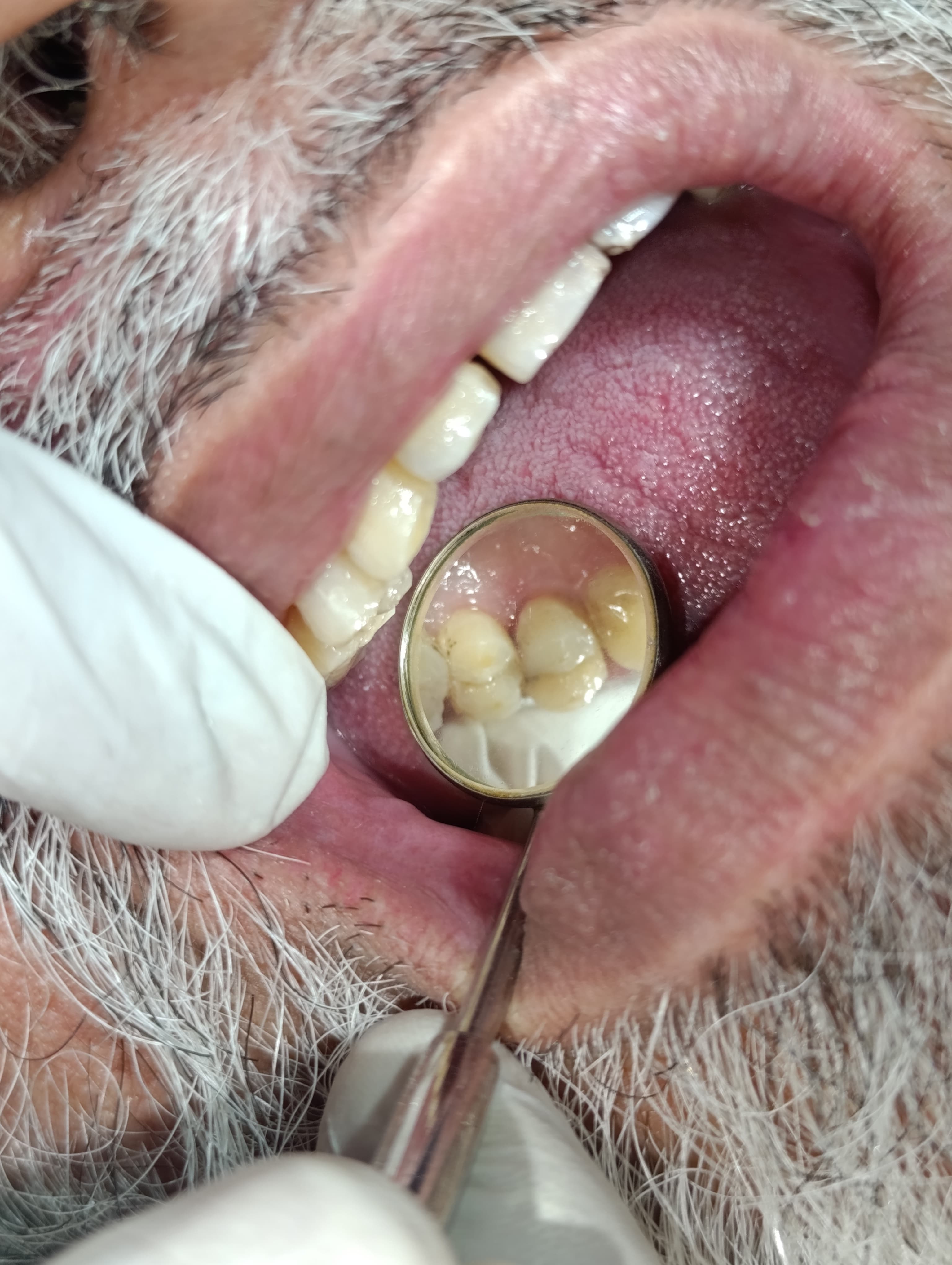 Composite Fillings before and after dental case