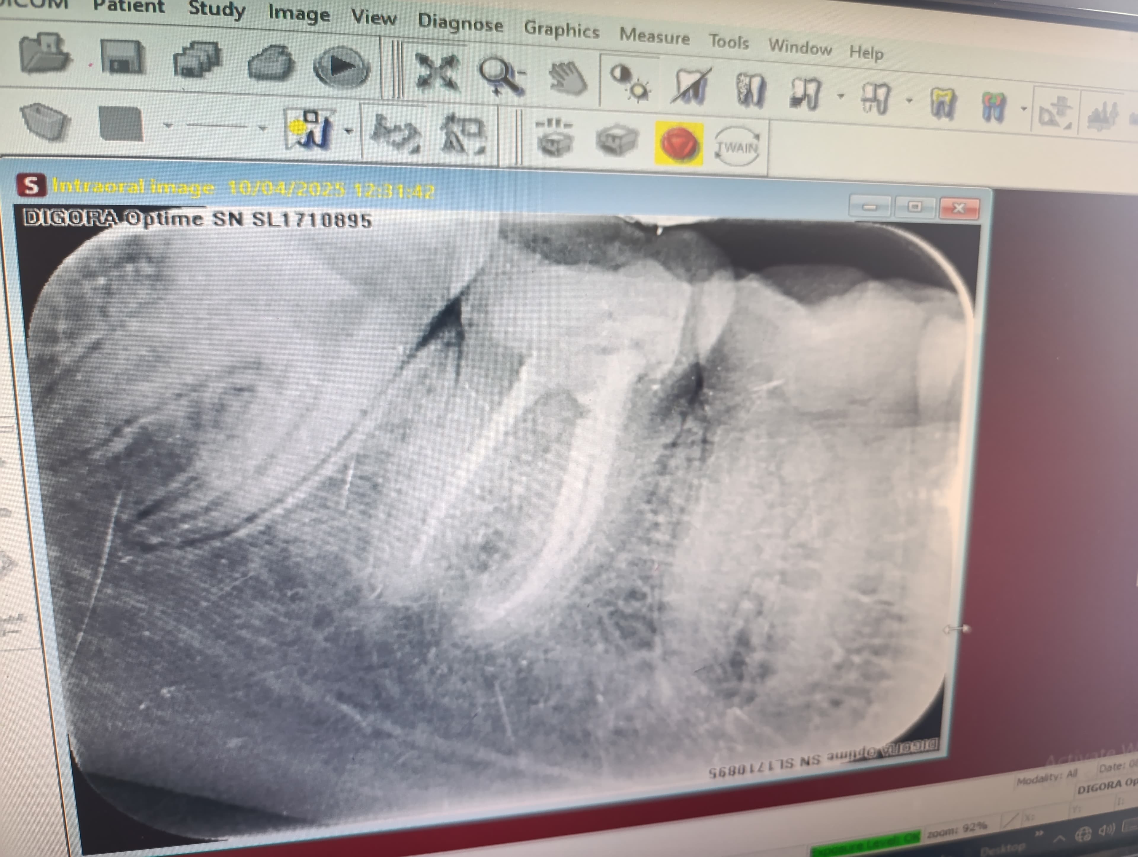 Root Canal Treatment before and after dental case