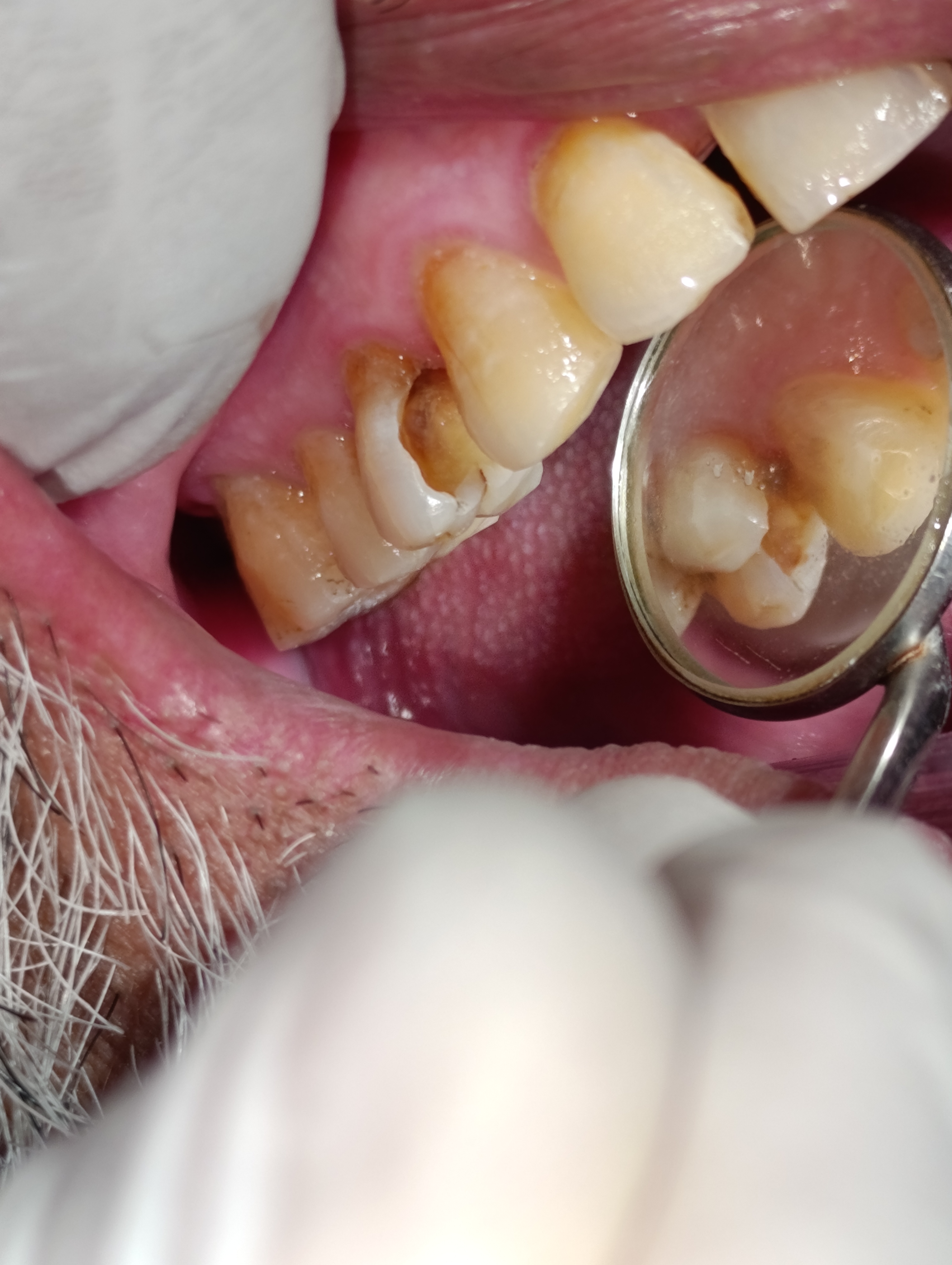 Pre-treatment view of Qari Sultan — proximal cavity visible at posterior contact