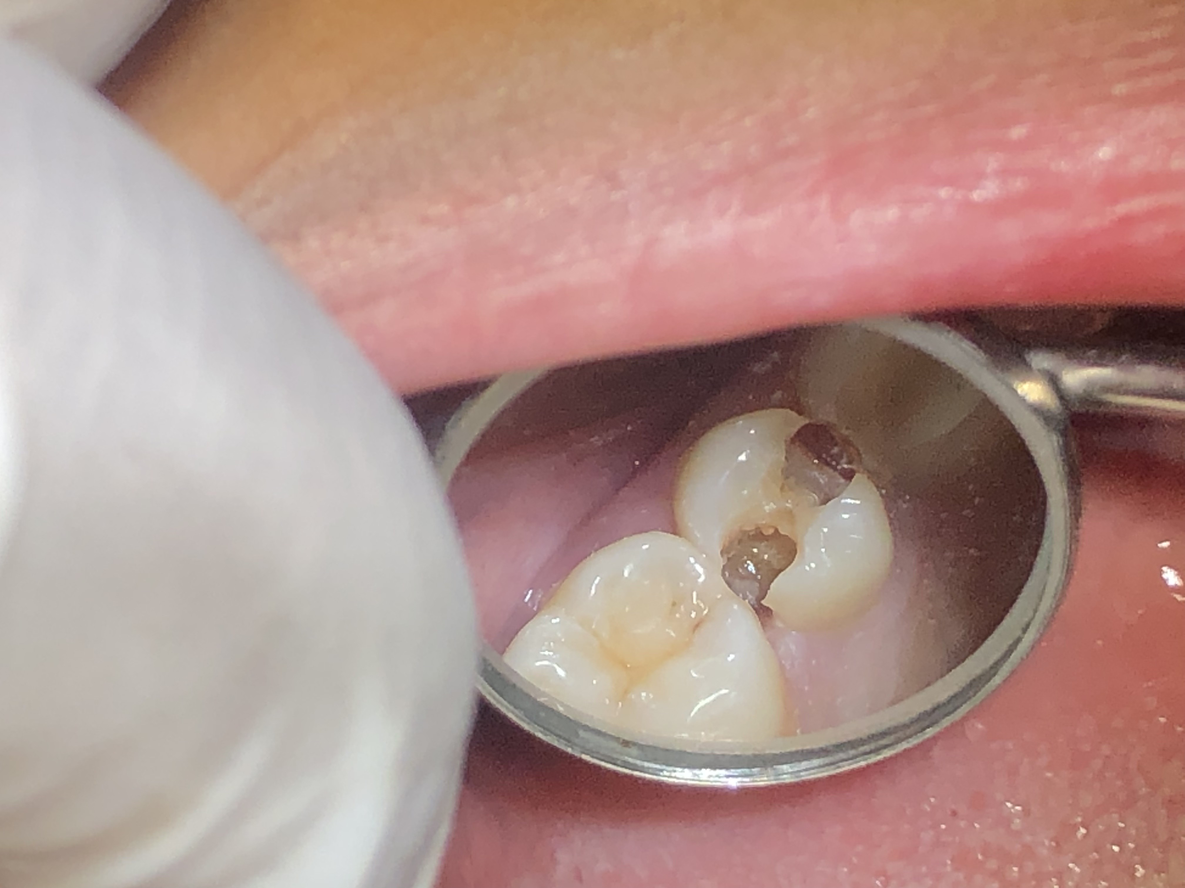 Pre-treatment view of Ms. Warda — bilateral proximal cavities