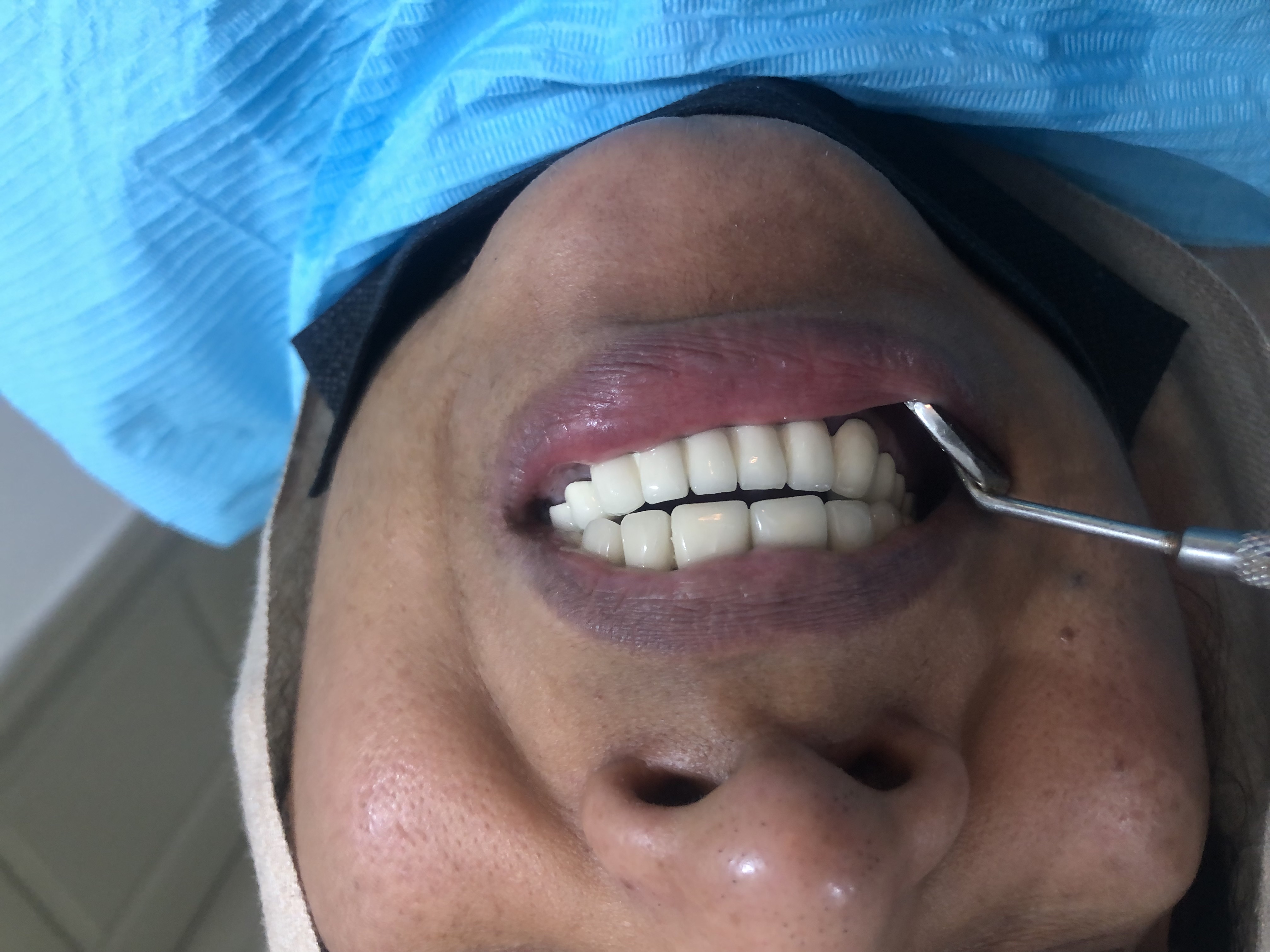Ms. Abida Rashid — Full-mouth bridge revision + endodontics + perio