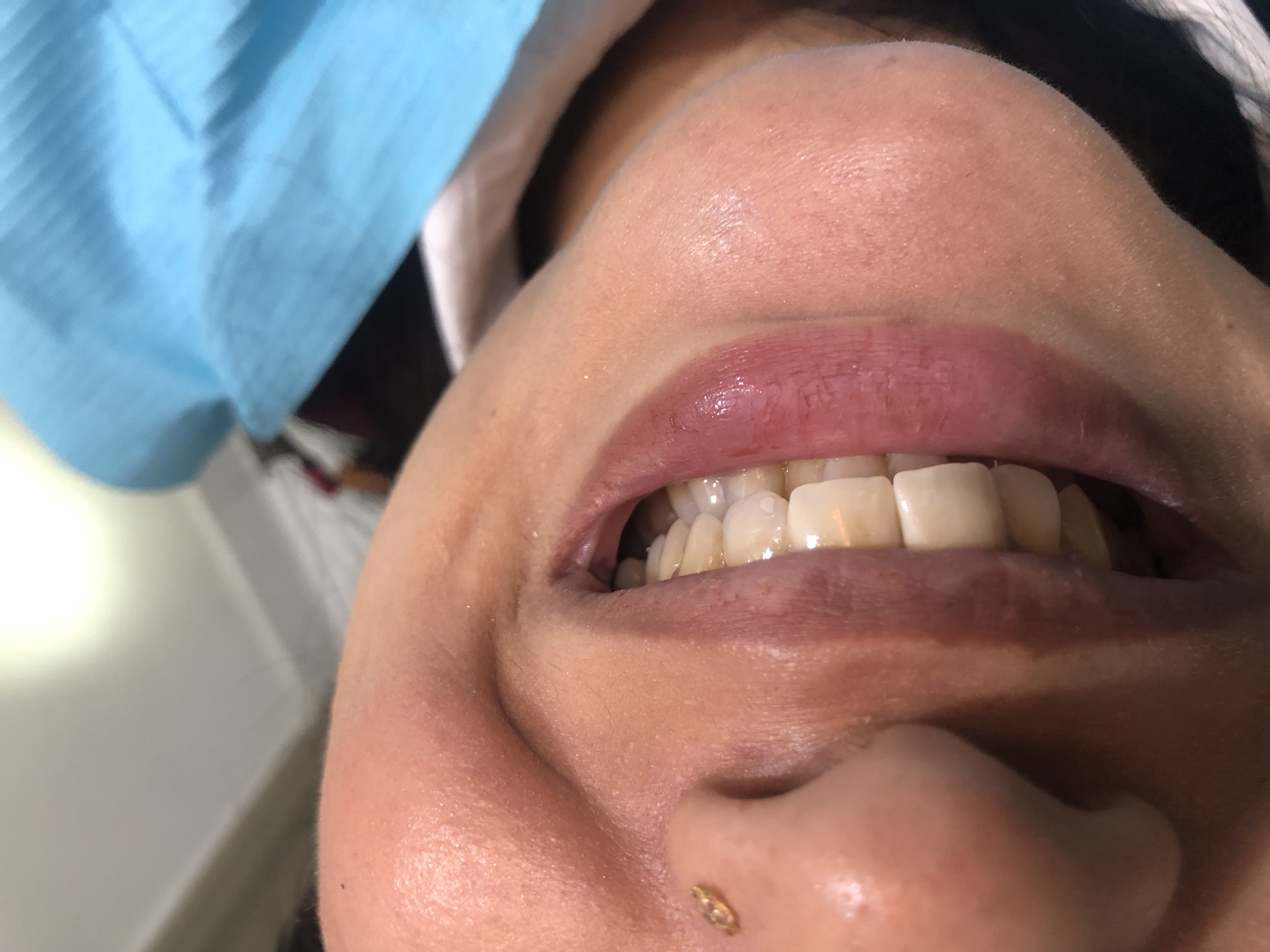Ms. Ammarah — crown bridge case