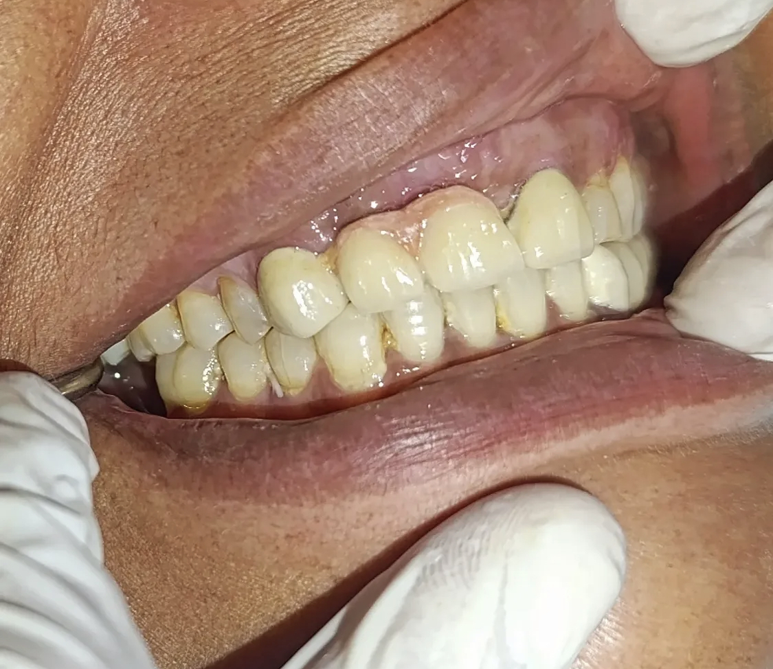 Pre-treatment view of Ms. Khalida — grossly carious upper anteriors and gum recession