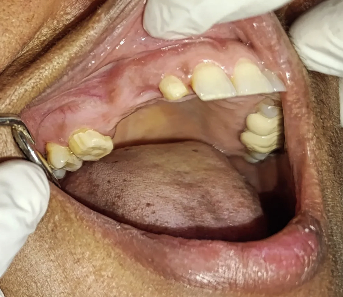 Pre-treatment view of Ms. Parveen — missing upper anterior teeth and reduced lip support