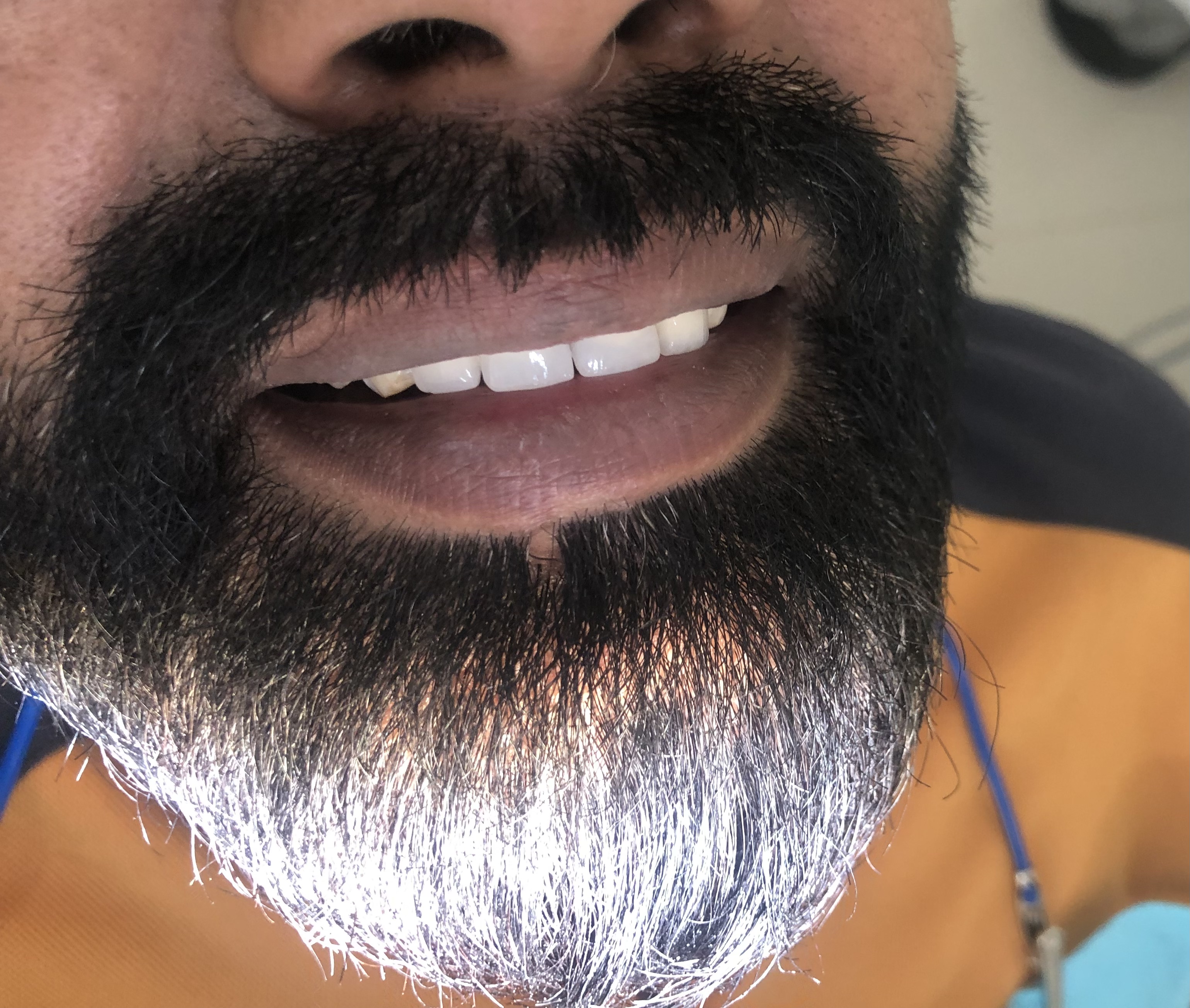 Mr. Sajid pre-treatment — wearing removable acrylic partial denture