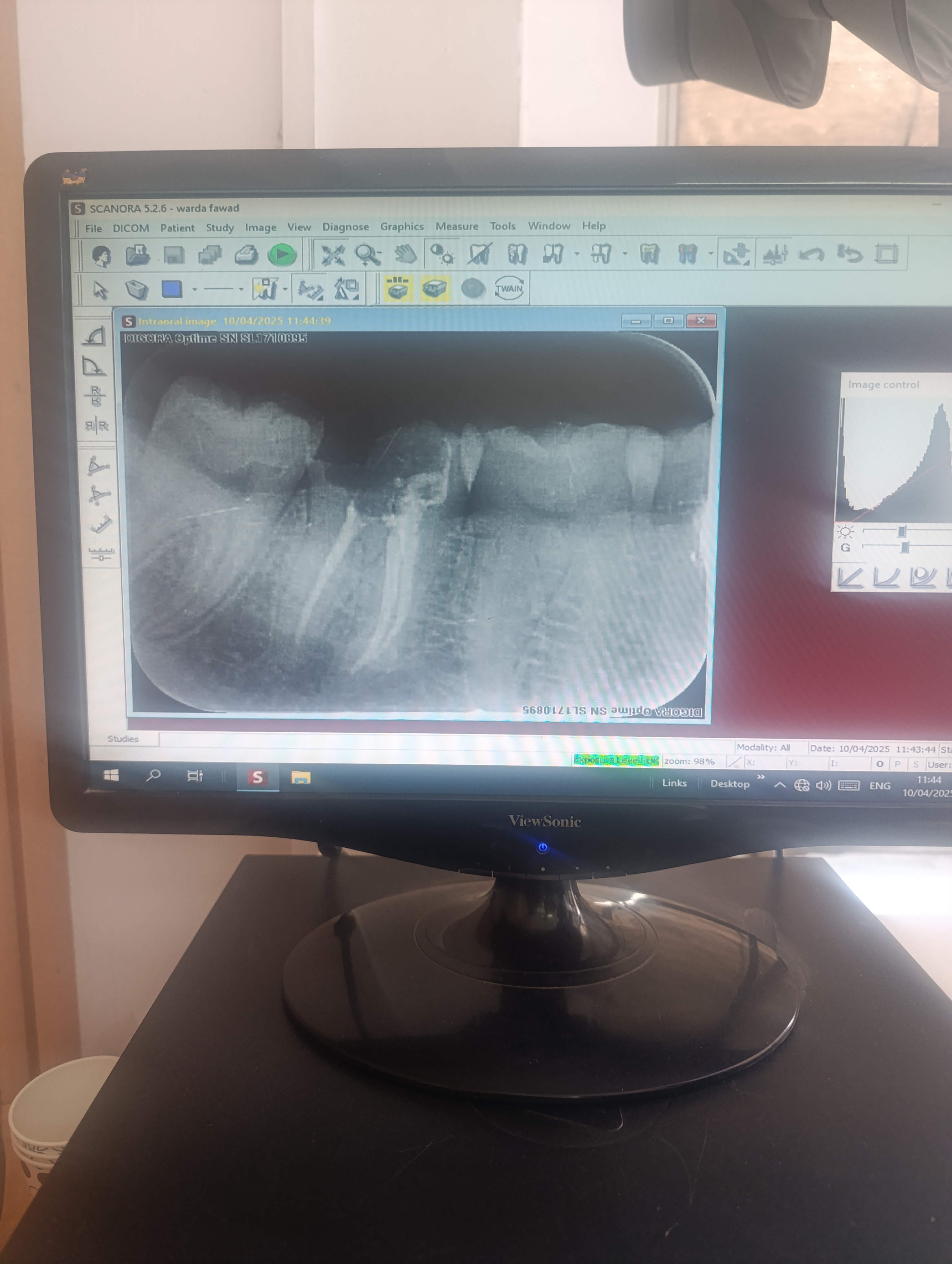Pre-operative radiograph of Mr. Mubeen — lower-left posterior tooth with deep caries