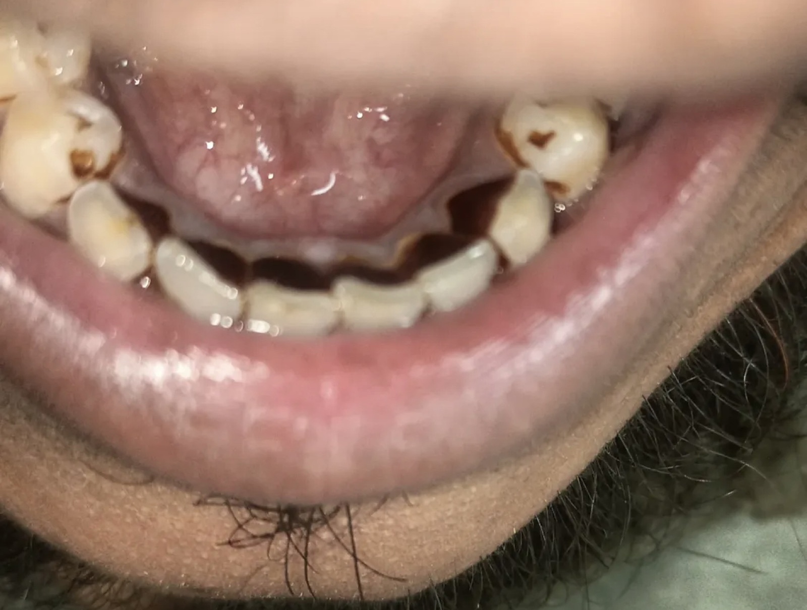 Lower-anterior close-up of Mr. Nawaz on day one — heavy band of tea stain visible at the gum line