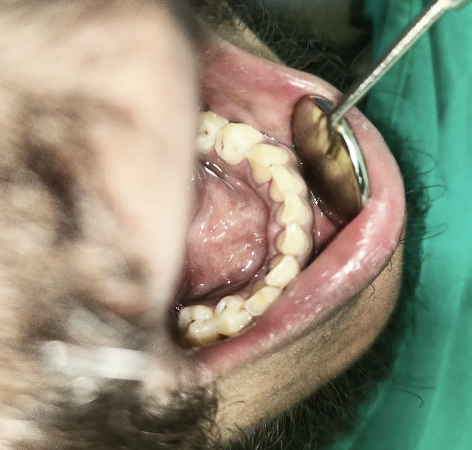 Mr. Nawaz — Odonto Lahore patient story