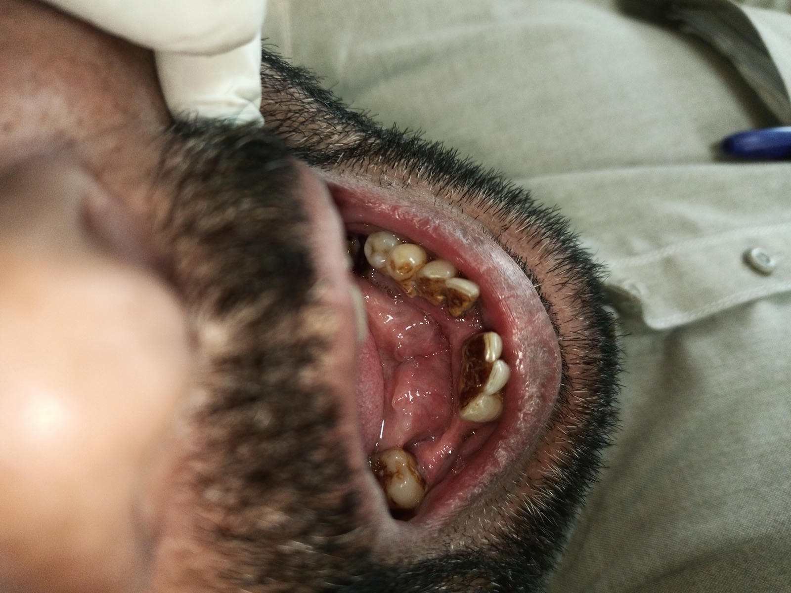 Lateral view of Mr. Azam on day one — posterior calculus deposits and tongue coating