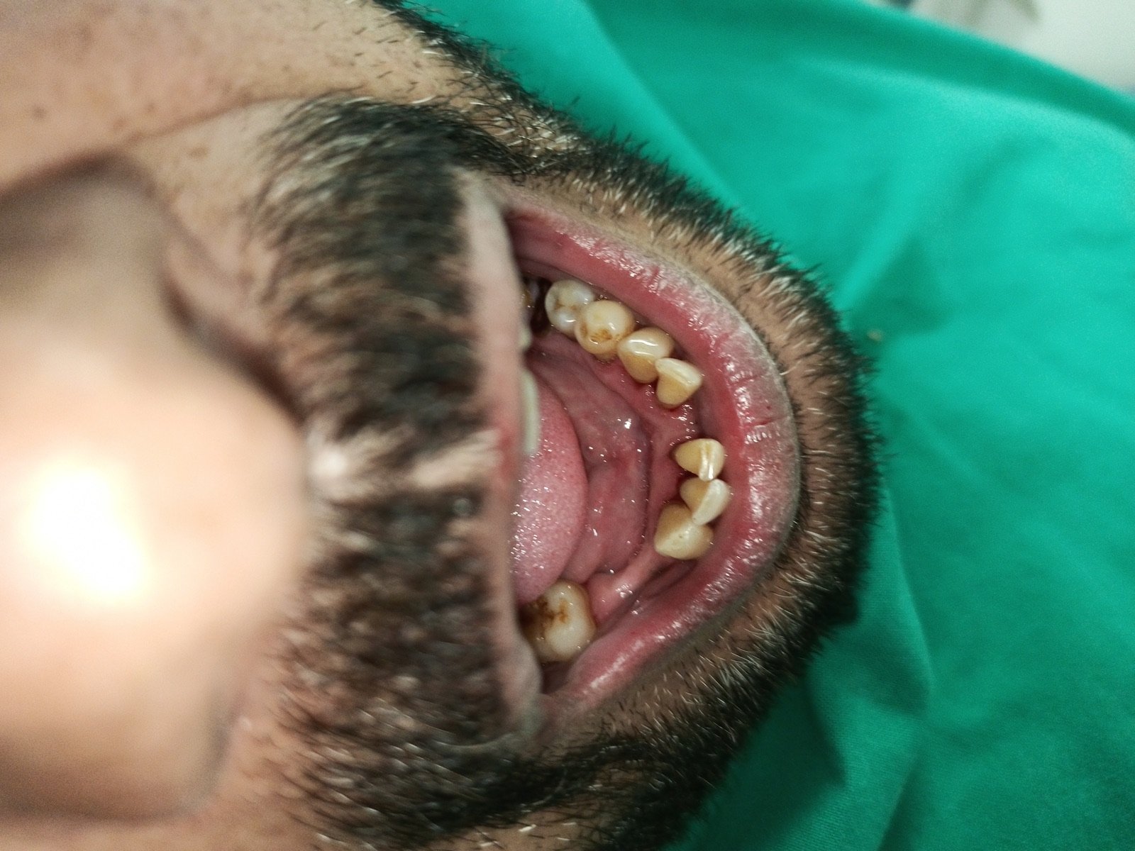 Mr. Azam — scaling and polishing case