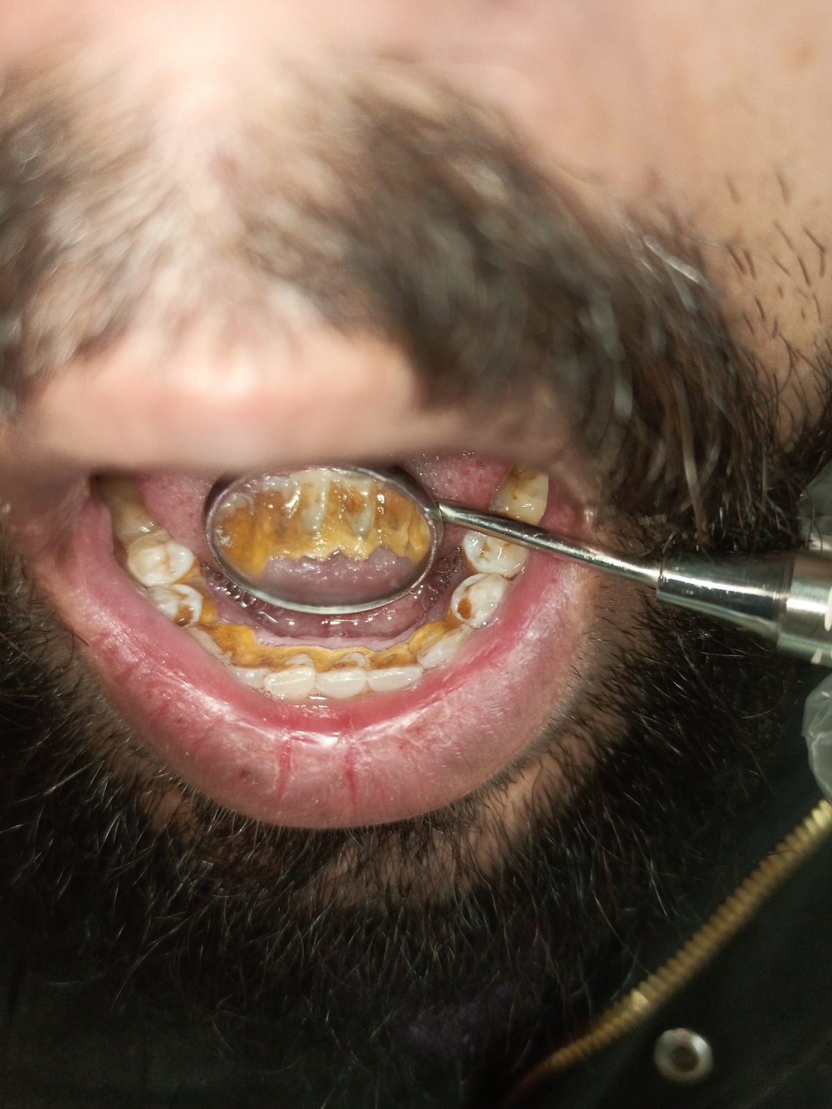 Close-up of Mr. Azam at the four-month recall — enamel clean, gum margins healthy