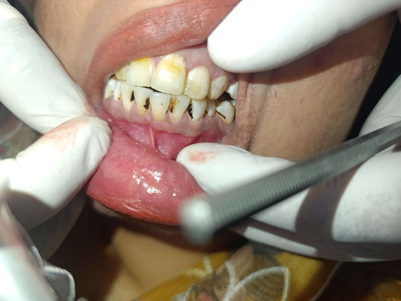 Upper-anterior close-up of Ms. Bilqees on day one — heavy band of chai stain visible at the gum line and proximal contacts