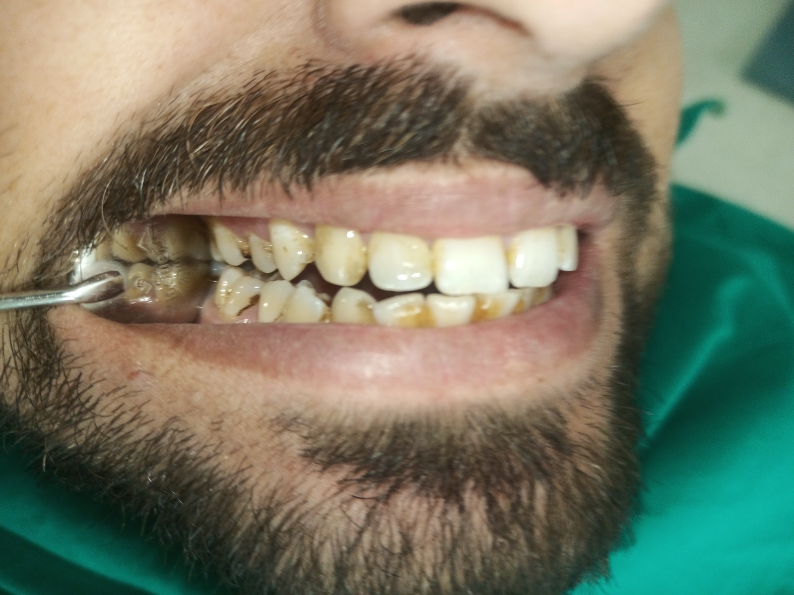 Lower-anterior lingual close-up of Mr. Imtiaz on day one — heavy supragingival calculus collar accumulating where his brush could not reach