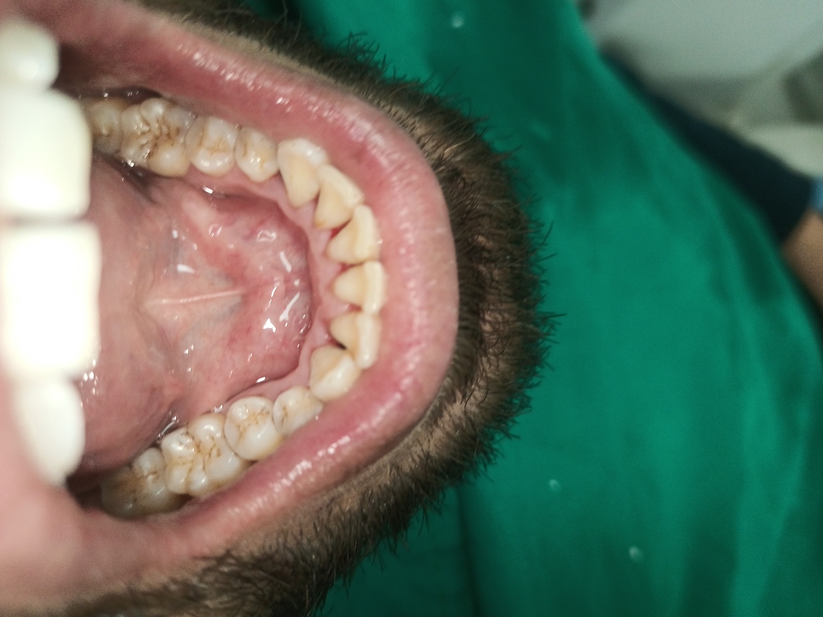 Close-up of Mr. Imtiaz at the four-month recall — calculus zone still clean, gum margins healthy, gingival contour fully restored