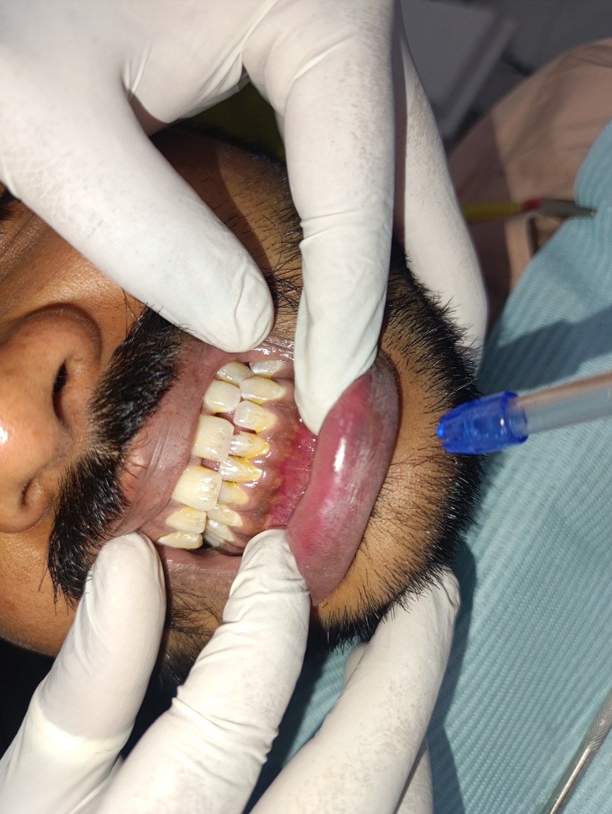 Lower-anterior close-up of Mr. Irfan on day one — calculus banding at the cervical margin and inflamed marginal gingiva