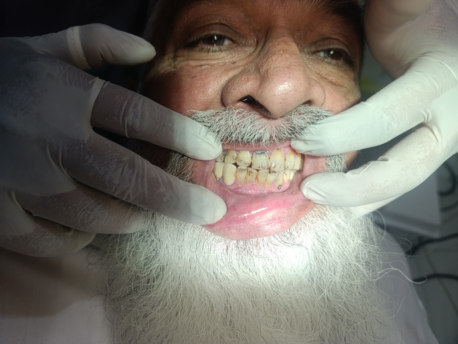 Pre-treatment close-up — dense black extrinsic stain masking enamel; suspected caries indistinguishable from staining
