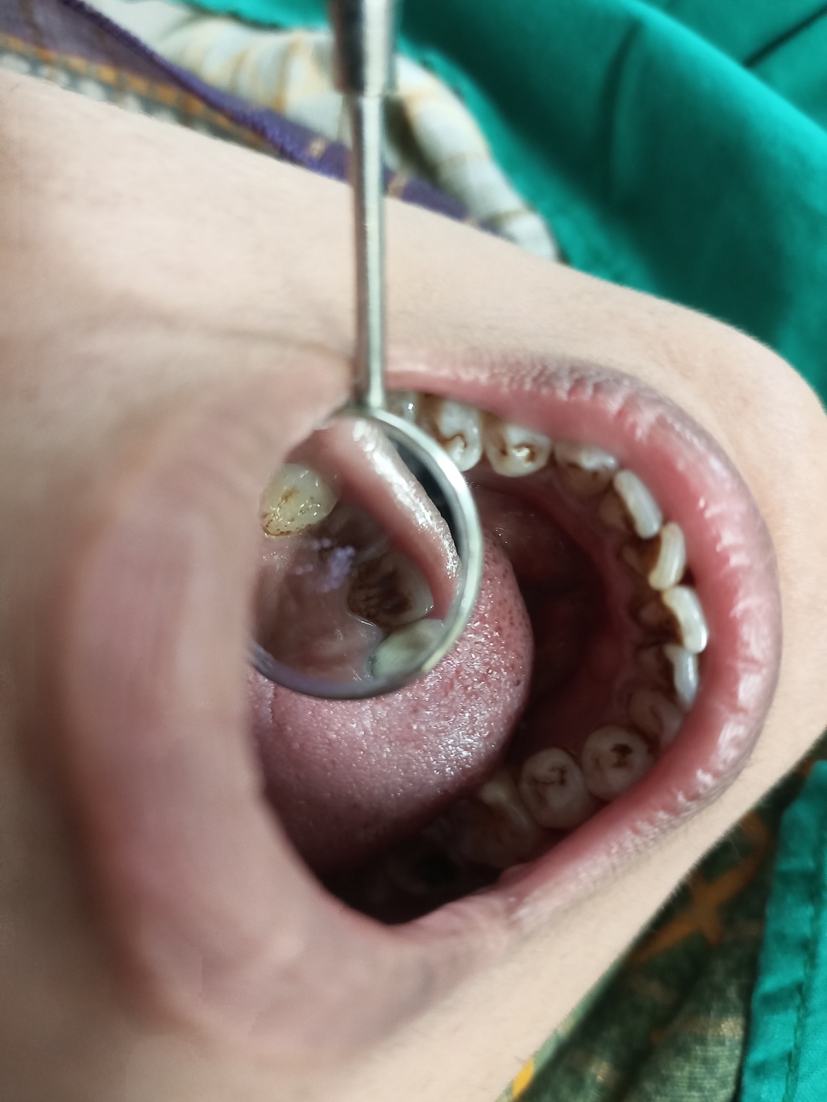 Close-up of Ms. Sameena at the six-month recall — surfaces still clean, gum margins healthy, sensitivity stable at Schiff 1