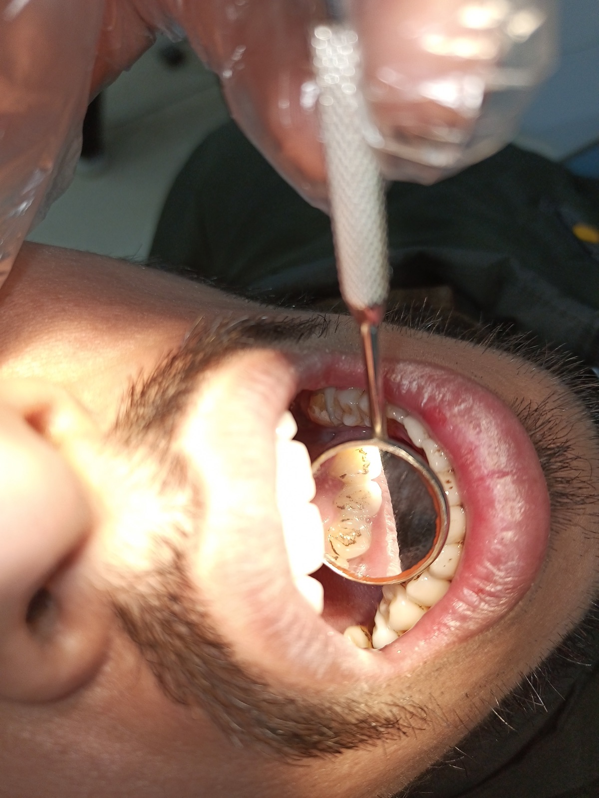 Mr. Subhan — Odonto Lahore patient story