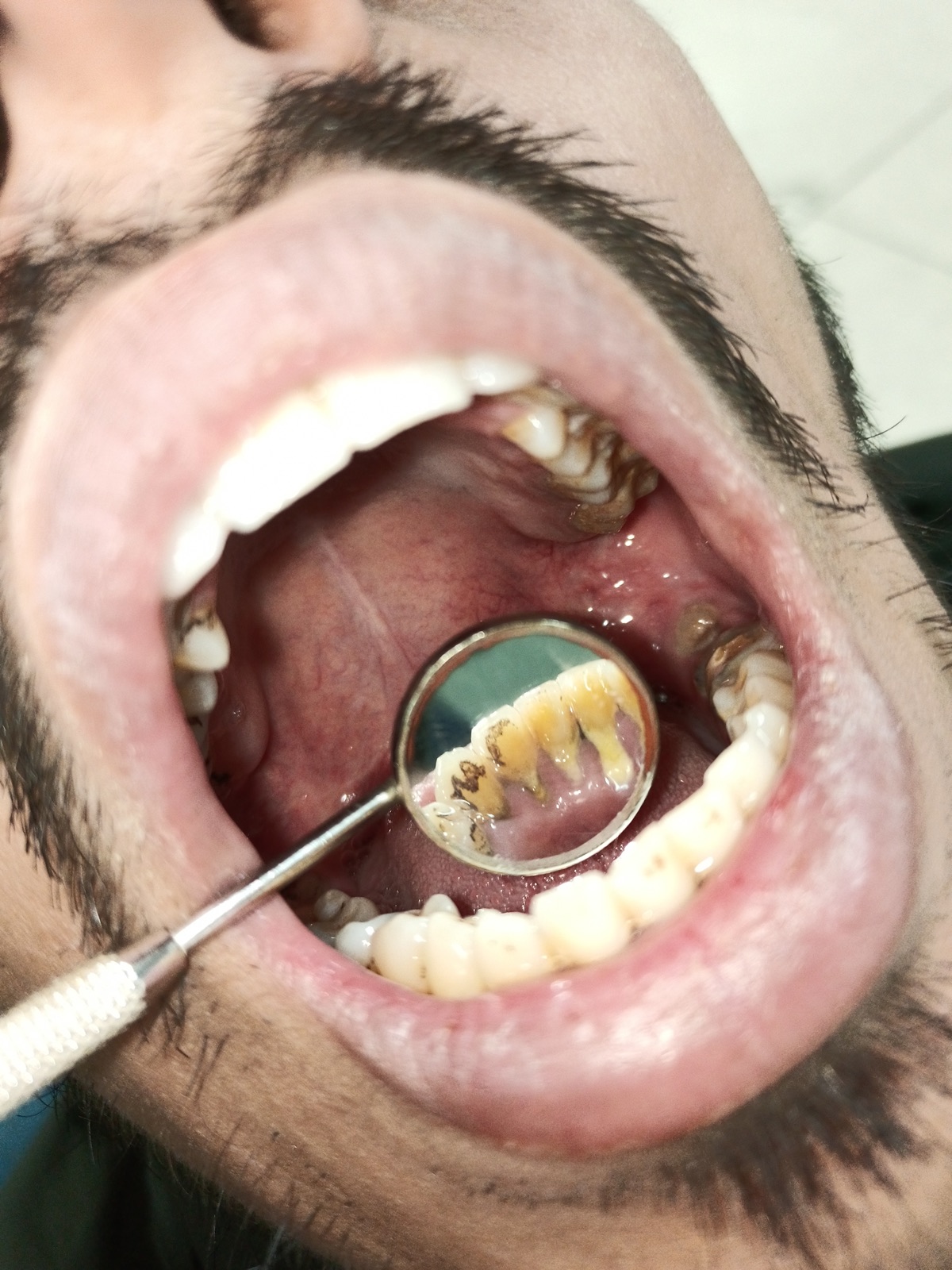 Mr. Subhan at the three-month re-charting — gum margins healthy, pockets closed, stable on the maintenance cycle