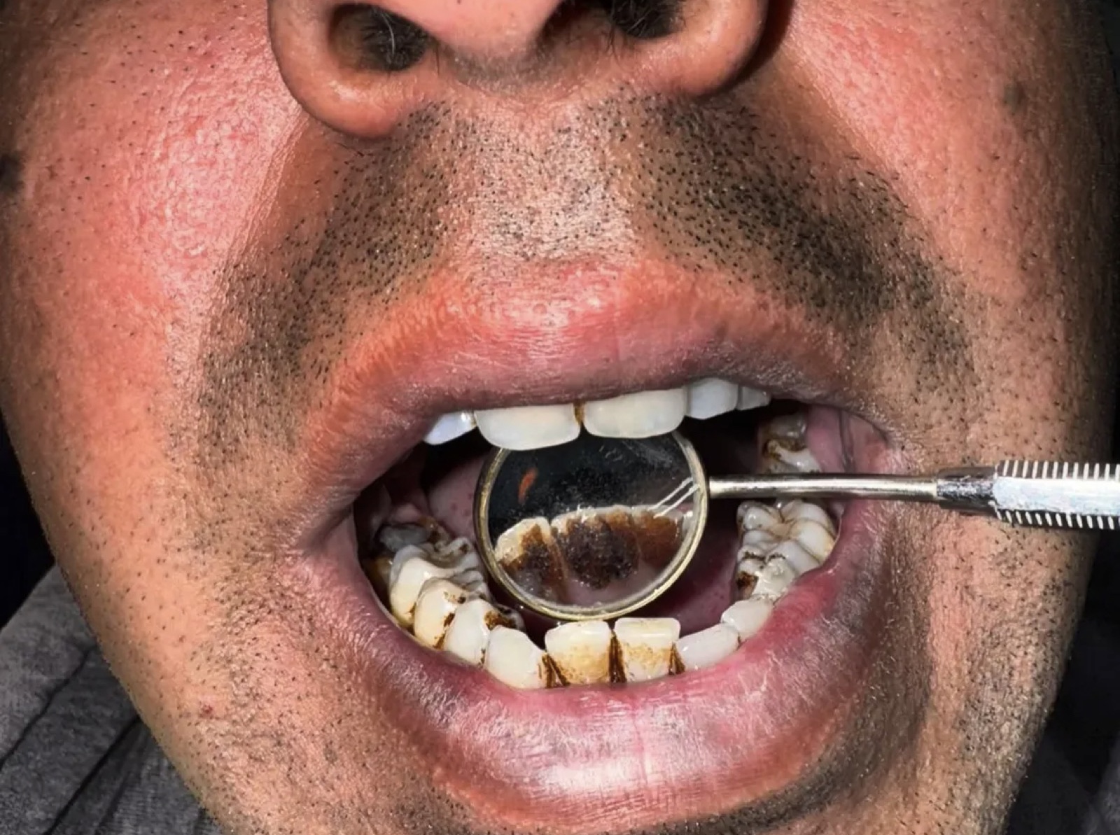 Day-one frontal view of Mr. Usman — heavy nicotine and tannin staining and inflamed gum margins