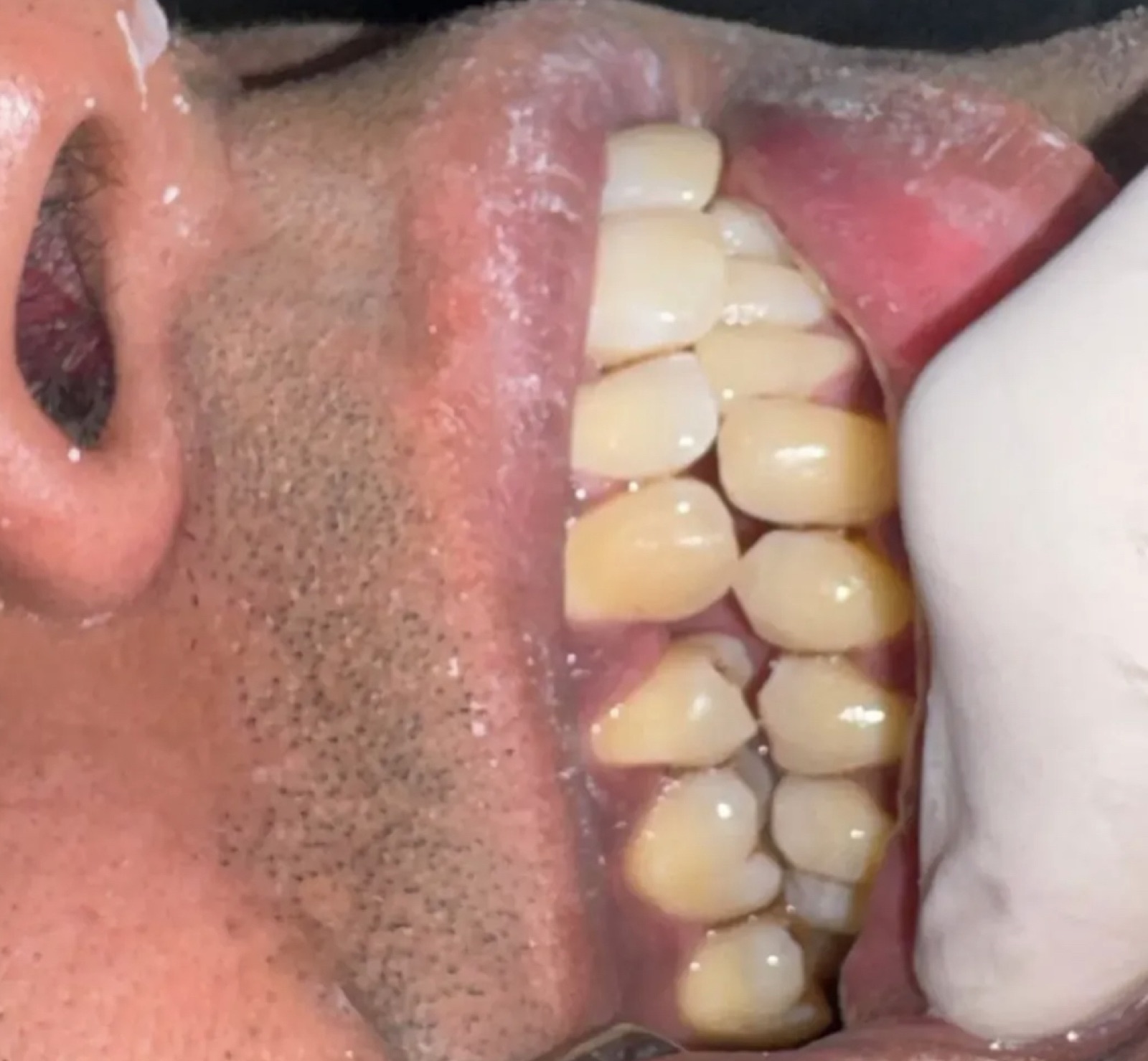 Mr. Usman — scaling and polishing case